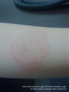 pruritic erythema on forearm. one red blotch with two dots inside. 