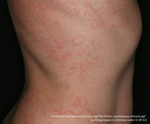 chronic spontaneous urticaria (chronic hives on skin) on the chest and abdomen 