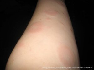 round hives and welts on the forearm. showing many raised red circles of hives on skin 