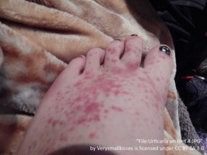 left foot with allergic urticaria. Hives are on the top of the foot with a few hives on each toe. 