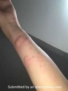 very swollen wheals under the arm with raised hives from allergies. Some of the hives on the skin are clustered together and swollen. Other hives on the skin are more spread out and less inflamed. 