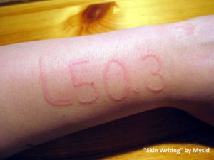 dermatographic urticaria or skin writing. using a ball point pen on the arm, it reads "L50.3" The swelling is only where the person wrote on their arm and did not cause any swelling outside of that area. 