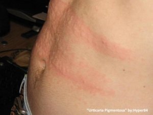 urticaria pigmentosa on stomach from skin rubbing together. A rash of hives is running across the stomach. IT looks like someone was sitting down, hunched over, so the skin was in contact with itself. This contact caused inflammation with hives. 