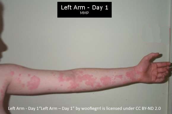 blotchy hives on the arm from the shoulder down to the palm on the hand