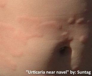 hives all around the belly button causing raised welts. image provided by "suntag"