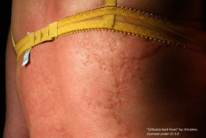 hives on woman's back and arms with raised red areas. the rash of hives on the skin is widespread (above and below the bra). 