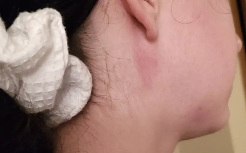 Picture of hives on skin/hives on the face and behind the ear on the right side of beautiful woman's face.