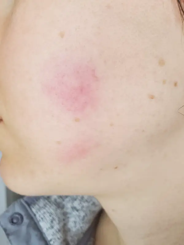 two hives on the left cheek of an adult woman. The top hive is bigger than the bottom hive. Both hives are red and blotchy.