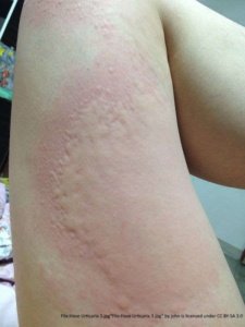 very large and raised wheal on thigh caused by hives. The swelling and redness takes up about 40 percent of the leg. 