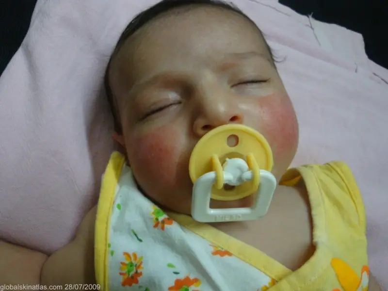 Sleeping baby with a pacifier in mouth. The infant's checks are red, dry, and rash-like. Baby diagnosed with atopic dermatitis, possibly caused by cow's milk protein allergy (CMPA).