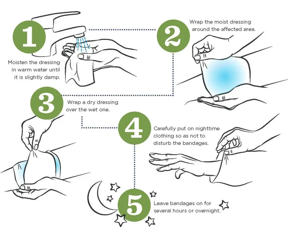 nationaleczema.org infographic instructions to applying a wet wrap for eczema. Step 1: Moisten the dressing in warm water until it is slightly damp. Step 2: Wrap the moist dressing around the affected area. Step 3: Wrap a dry dressing over the wet one. Step 4: Carefully put on nighttime clothing so as not to disturb the bandages. Step 5: Leave bandages on for several hours or overnight. 