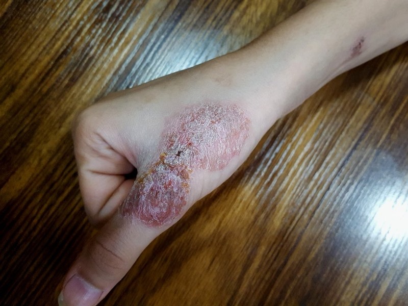 Nummular eczema on the right hand of an adult. The dermatitis is cracking and blistering over the right thumb knuckle.