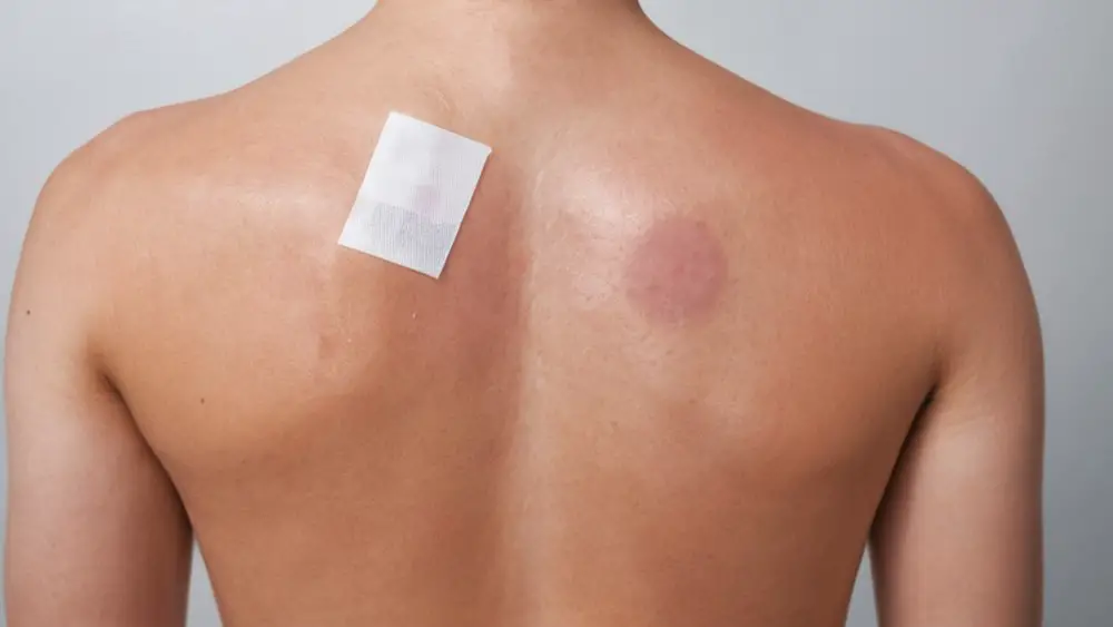 Allergy patch testing on a person's back. one side has a covered patch, and the other side has an allergic reaction with redness and swelling.