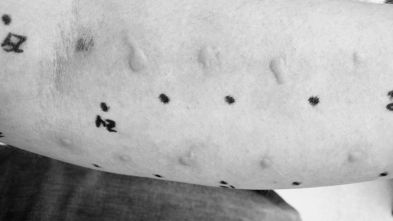 allergy testing skin prick test or scratch test image. large raised welts or wheals observed on the forearm from allergy testing