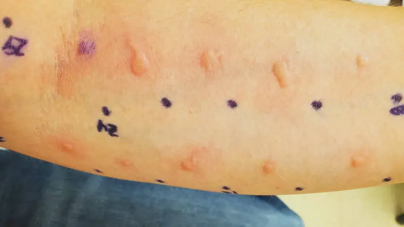 allergy skin prick test (SPT) showing wheals or hives from an allergic response on my forearm.