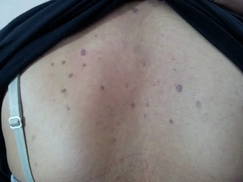 Atrophic dermatitis on the back of a female. A lot of dark purple or brown spots are seen on her upper back.