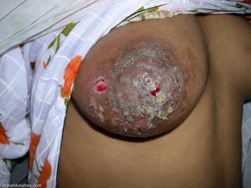 Severe case of beast eczema on the woman's right breast. The nipple area is red, flaky, and has broken skin. 