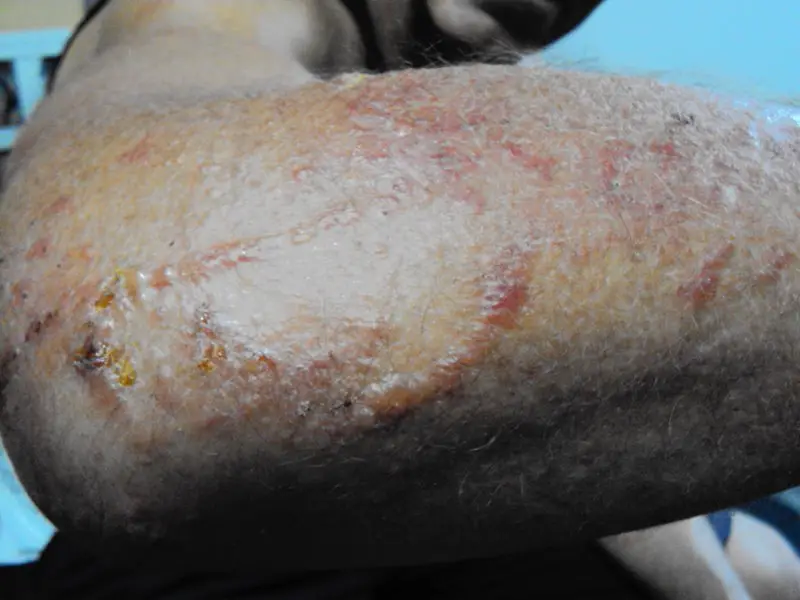 A 47-year-old man with contact dermatitis from a bush. The arm shows blisters that are oozing.