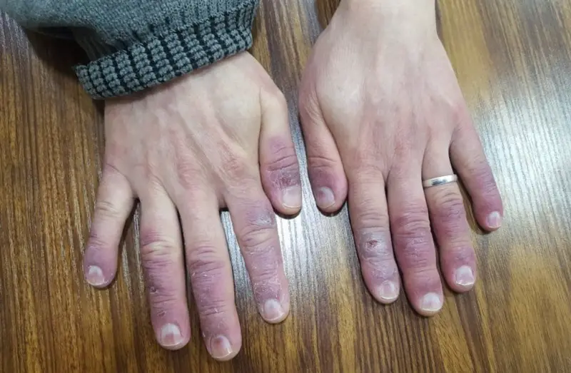 Atopic-dermatitis (eczema) on the finger tips of both hands. The hands are dark purple with many open wounds or blisters. The skin is dry and cracked.