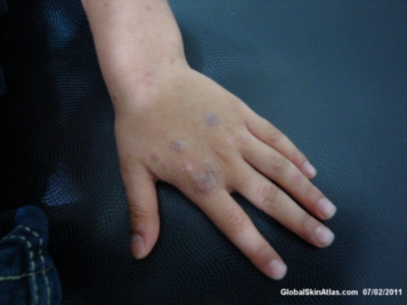 Lichenoid dermatitis on the top of the left hand. Some of the raised bumps are large and clustered, where others are small and by themselves.