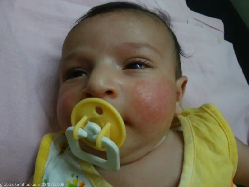Infant with a yellow binky, with scaling red cheeks. baby was diagnosed with infantile atopic eczema, commonly seen in CMPA/CMA cases.