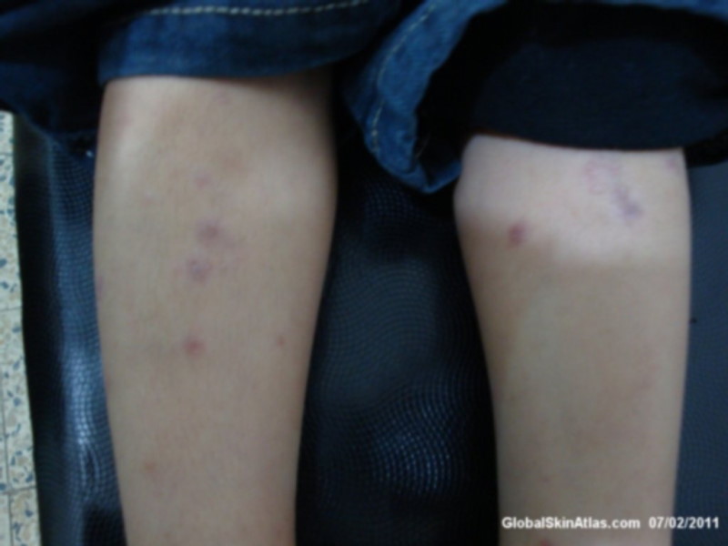 Lichenoid dermatitis on both legs. Minor papules are present and are either red, or dark purple.