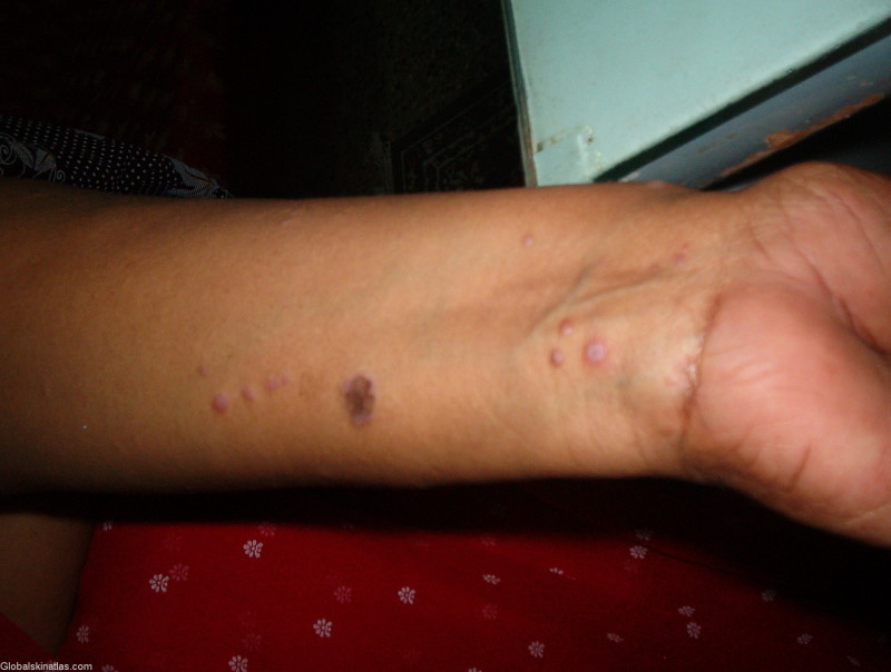 Lichen Planus (LP) violaceuous papules on the wrist. The bumps are raised, and look purple.