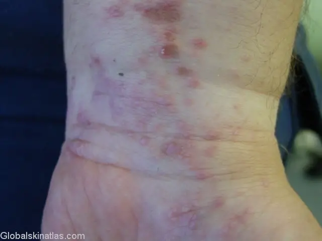 Lichenoid Eczema inside the wrist. Many little red dots cover the wrist, some have broke open and scabbed. The dermatitis looks to be spreading down the wrist and into the palm area of the hand.