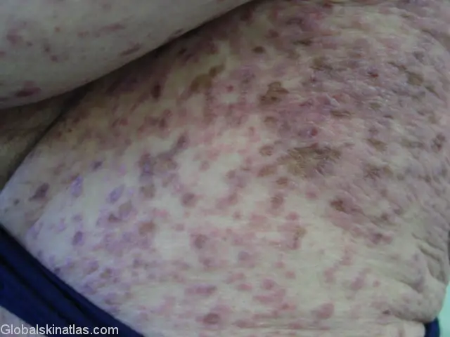 Severe Lichen Planus (LP) with hyperpigmentation on the thigh. Many painful looking red papules are seen on the majority of the skin. Some blistering and scabbing is present.