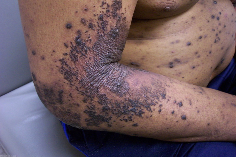 A prurtic eruption of lichen on the arm and trunk of an adult male. The papules are very clumped together and are deep purple in color.