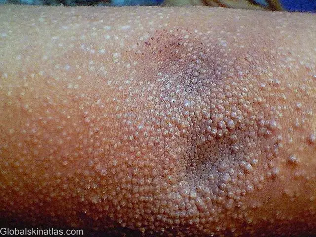 A detailed image of tightly clusted eczema papules on the elbow. There are many little raised bumps all over. The bumps are white on the tops, similar to the look of dry skin.