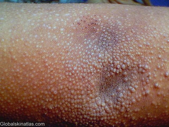 A detailed image of tightly clusted eczema papules on the elbow. There are many little raised bumps all over. The bumps are white on the tops, similar to the look of dry skin.