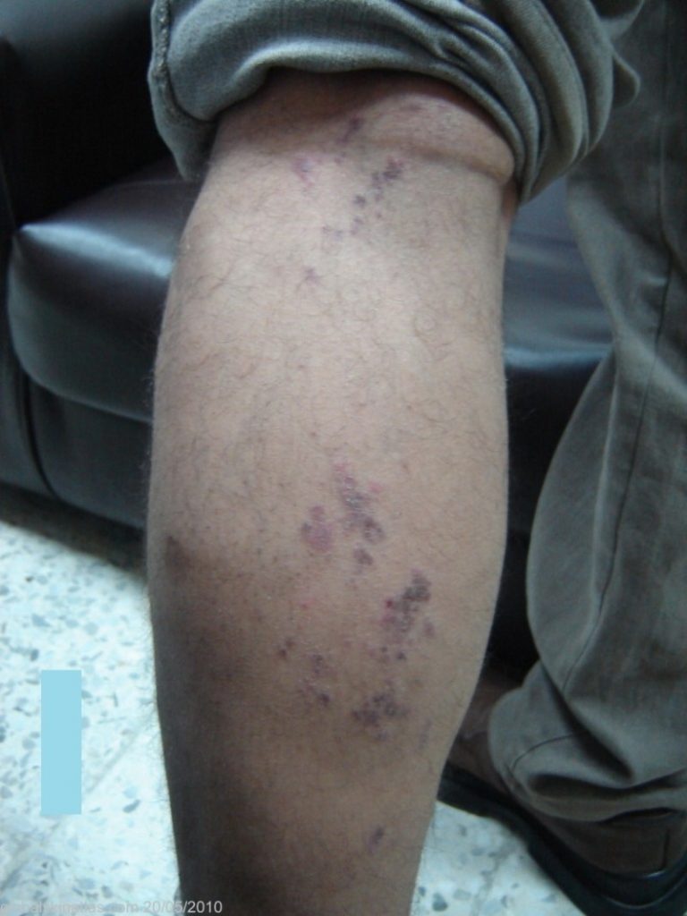 Dark puple eczema on the leg/calf. These raised bumps are sporatic on the leg and are not really clustered.