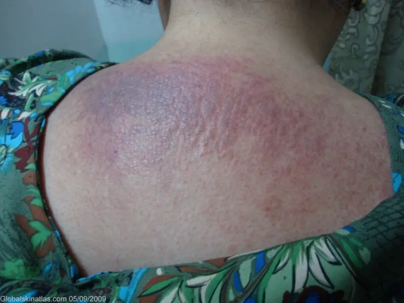 Lichenoid Dermatitis covering the upper back skin from shoulder to shoulder. The eczema is tightly clumped and ranged from a dark red to a dark puple in color.