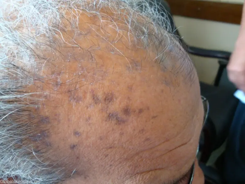 Dark purple lichenoid dermatitis spots are seen on the forehead and scalp of an adult male.