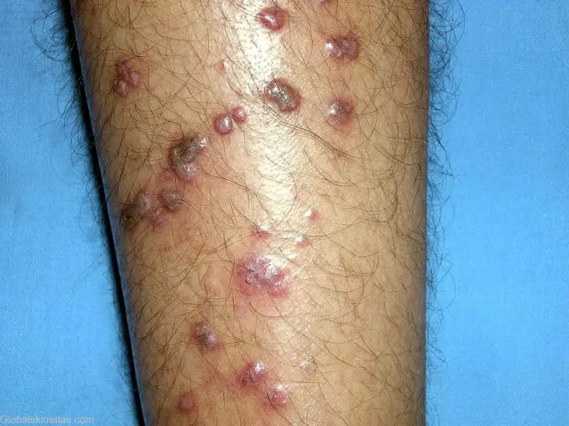 Pruritic polygonal lichenoid dermatitis papules on the shins. These are very painful looking irregular-shaped purple bumps on the shins of an adult male.