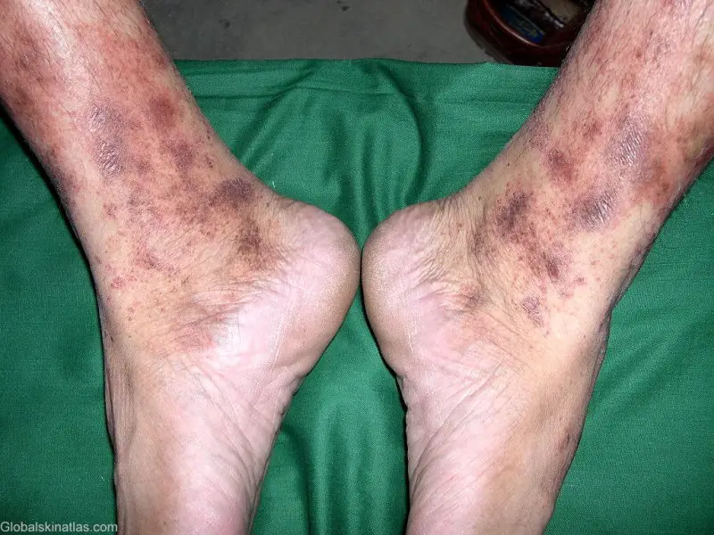 lichenoid dermatitis on both ankles of an adult male. The patches are thick and dark, and grouped together.