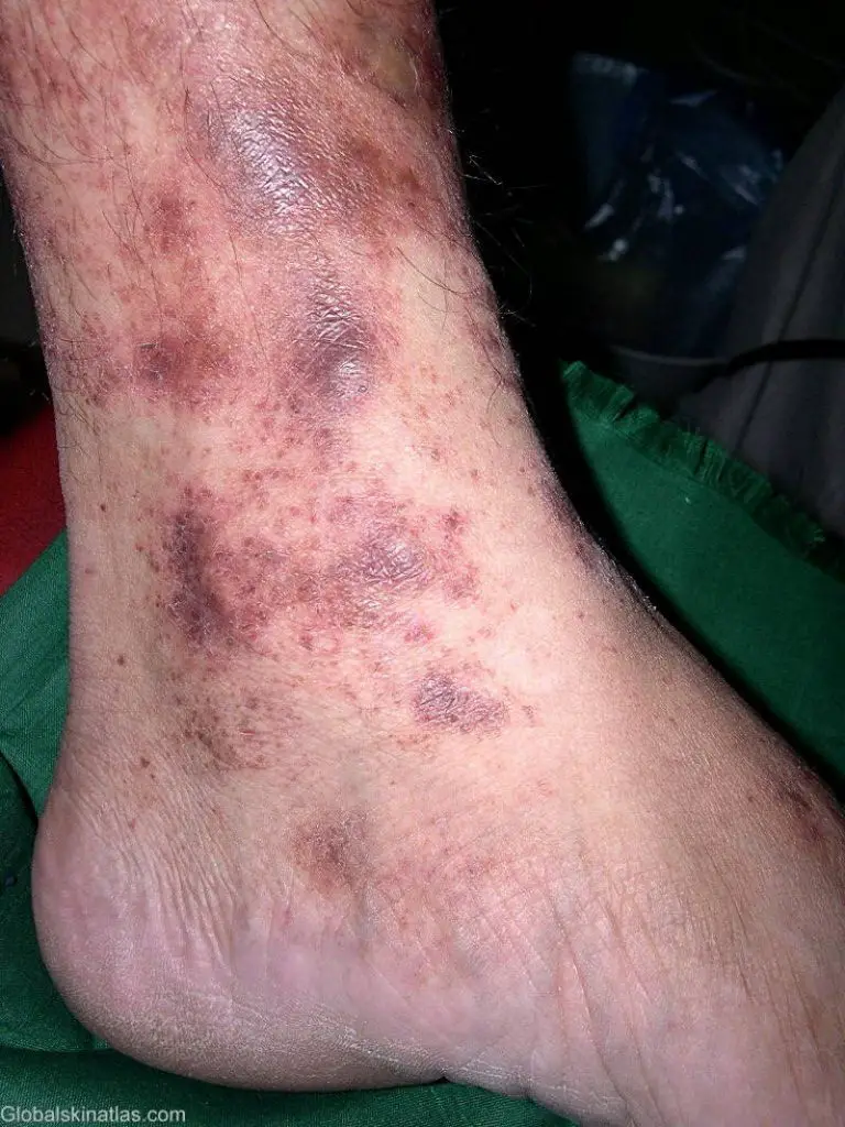 lichenoid pigmented eczema closeup. The images shows dark purple, dry, and craked patches of skin on the left ankle.