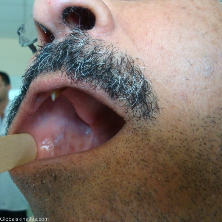 Lichenoid Planus (LP) in the form of red bumps inside the cheek of an adult male.