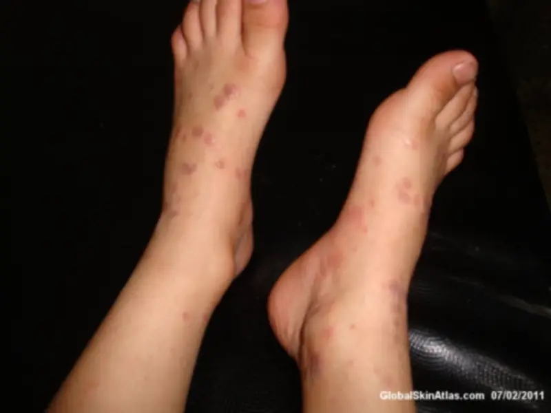 Lichenoid polygonal dermatitis on both feet of a child. The eczema is irregular shaped and has a shiny appearance.