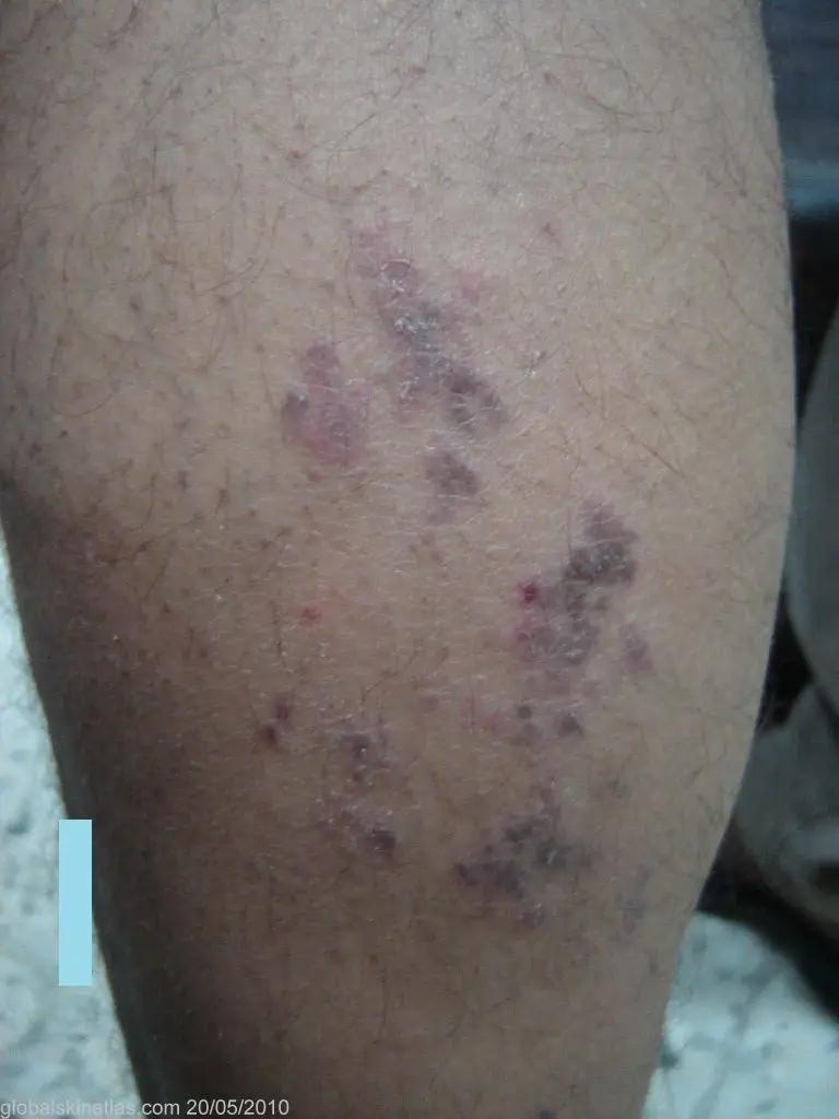 Lichenoid violaceous seen on the legs. The dermatitis is raised, purple, and the skin looks dry and damaged.