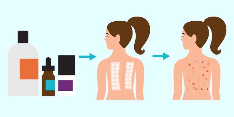 allergy skin patch test infographic.