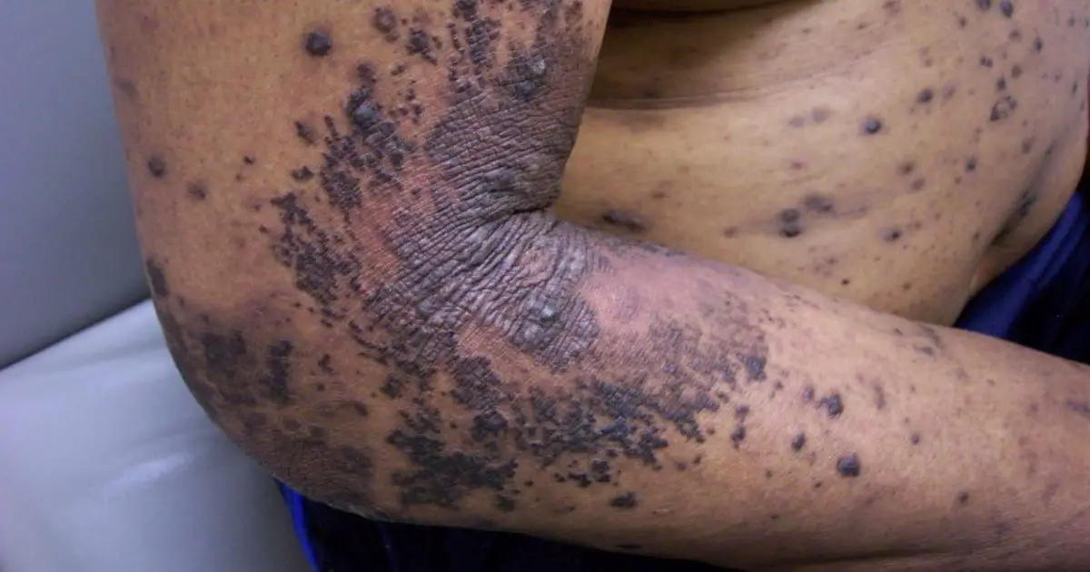 pictures of lichenoid dermatitis on the arm and trunk of an adult male.