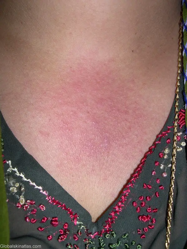 woman with sun allergies on her chest (PLME). A dark red patch with tiny bumps on the chest area just below the neck.
