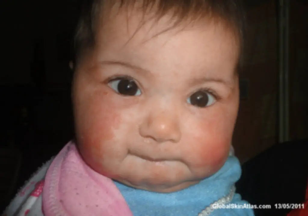 Image of a baby with red rash on both cheeks. The right cheek has a rash up to the baby's eye. This is an atopic dermatitis rash, with the possible cause of CMPA/CMA, cow's milk allergy.