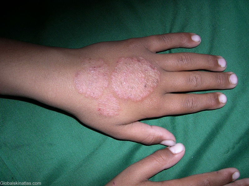 ringworm on left hand of a child caused by tinea dermatophytosis. Three different sized ringworm lesions are seen on the top of the hand. Some of the skin has broken and shows minor blistering.