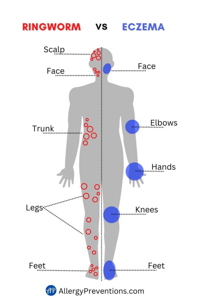 Ringworm vs eczema infographic describing where on the body ringworm and eczema is most commonly found. Ringworm is most commonly found on the scalp, face, trunk, legs, and feet. Eczema is most commonly found on the face, elbows, hands, knees, and feet.