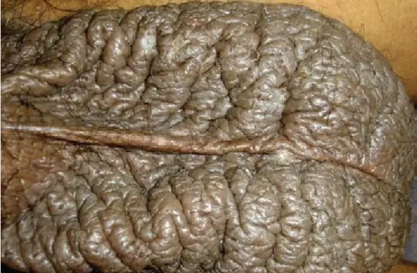 scrotal eczema on a dark skinned male. scrotum shows mild inflammation directly in the center of the scrotum. There also looks to be a small blister. 