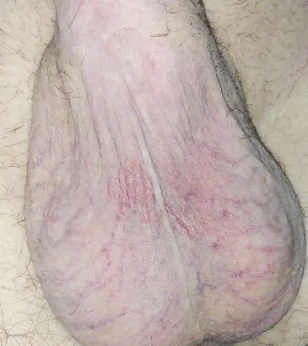 scrotal dermatitis cause by oral medications. redness, swelling, and scabs present on both sides of the scrotum. 