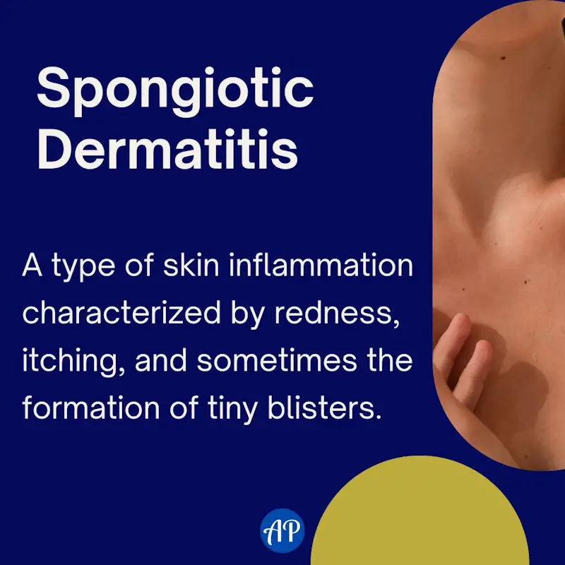 Spongiotic Dermatitis Definition Infographic. Spongiotic Dermatitis is a type of skin inflammation characterized by redness, itching, and sometimes the formation of tiny blisters.
